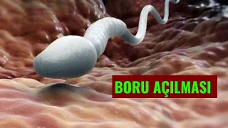 Hamilə qala bilməyən  QADINLAR baxsın! - Boru açılması