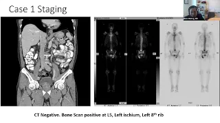 Treatment for Hormone Sensitive Prostate Cancer (2023) - English