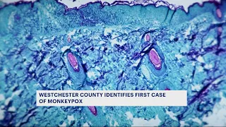 Officials: Presumed case of monkeypox found in Westchester
