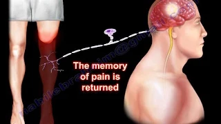 Phantom Pain Amputation - Everything You Need To Know - Dr. Nabil Ebraheim