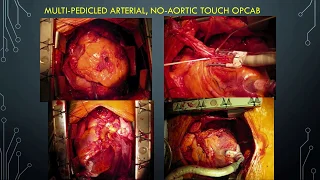 PCI vs CABG for Diabetes and Cardiovascular Risk