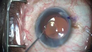 iTrack™ Procedural Steps: Viscodilation