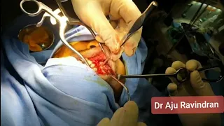 Orbital floor repair for Blow out fracture by sublabial (Caldwell Luc )approach