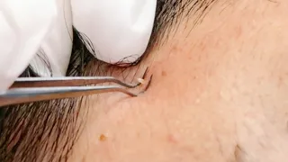 ASMR INGROWN | Whiteheads Face Extractions Treatment |  soft whispers ~ allzoomed