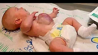 Miracle baby born with heart outside the body. Baby born with rare birth defects. Ectopia cordis