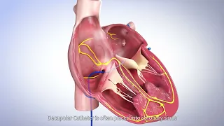 SinusFlex™ decapolar mapping catheter - Redefining CS placement