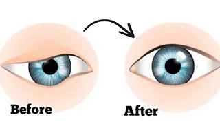 Tighten Droopy Eyelids | 14 Days Massage Plan | 100% Guaranteed