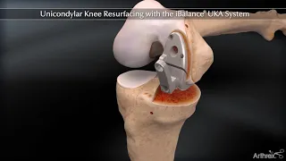 Unicondylar Knee Resurfacing with the iBalance® UKA System