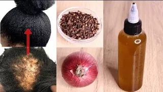 MIX ONIONS & CLOVE AND YOUR HAIR & BALDNESS WILL GROW 3 TIMES UNSTOPPABLE FASTER