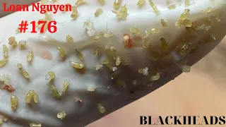 Blackhead extract and hidden acne (176) | Loan Nguyen