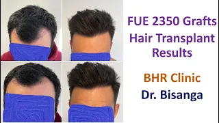 FUE Hair Transplant Results 2350 Grafts | 0-8 Months | Dr. Christian BISANGA | BHR Clinic