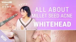 Skincare Routine to Remove Millet Seed Acne AKA WhiteheadsㅣWishtrend TV VS Acne