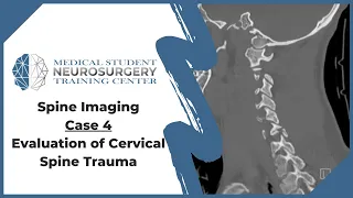 Spine Imaging Case 4: Evaluation of Cervical Spine Trauma