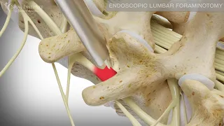 Endoscopic Lumbar Foraminotomy | Spine Institute of North America