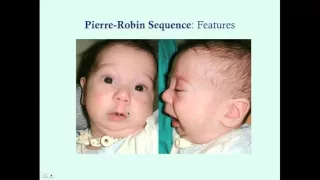 Pierre Robin Sequence - CRASH! Medical Review Series
