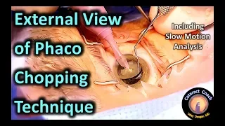 Learning from an External View of Phaco Chop during Cataract Surgery