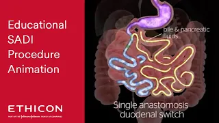 Animation of Single Anastomosis Duodenal Switch (SADI) Procedure | Ethicon
