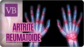 Artrite Reumatoide - Você Bonita (28/11/17)