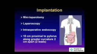 S034 GASTRIC ELECTRIC STIMULATION FOR SEVERE GASTROPARESIS