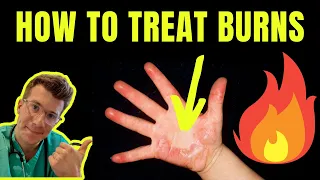 HOW TO TREAT AND MANAGE BURNS AND SCALDS | DOCTOR EXPLAINS (plus first aid tips)