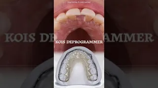 Kois Deprogrammer Demystified