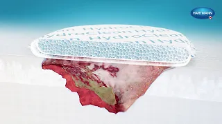 Wound Debridement with HydroClean | Medical Animation