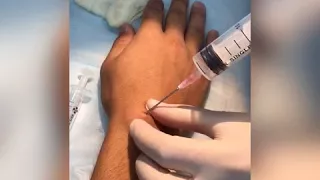 Пункционной метод  лечение гигромы кисти в Уфе