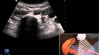 3D How to: Abdominal Aorta Ultrasound - SonoSite Ultrasound
