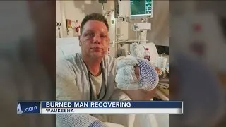 Waukesha man severely burned after grease fire