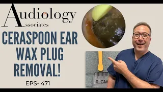 CERASPOON EAR WAX PLUG REMOVAL - EP 471