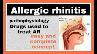 Allergic Rhinitis , symptoms ,  pathophysiology, Drugs used to treat AR, adverse effects.