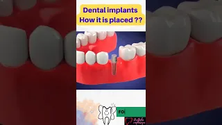 #shorts #dentalimplants #dentistry #dental #dentist #dentalimplant #youtubeshorts