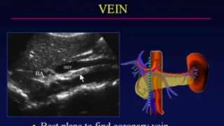 Ultrasound Evaluation of Portal Hypertension