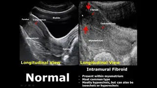 Uterus Ultrasound Normal Vs Abnormal Image Appearances Comparison | Uterine Pathologies USG