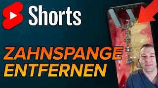 Zahnspange entfernen #shorts