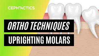 Up righting molars in Orthodontics