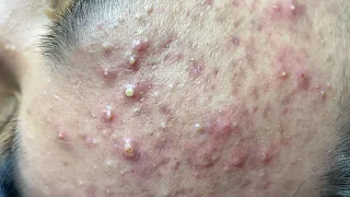 Super Satisfying BLACKHEAD REMOVAL