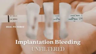 IMPLANTATION BLEEDING **WITH PICTURES | Two Week Wait, Bfp / Bfn Symptoms