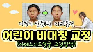 어린이 얼굴비대칭, 아데노이드얼굴 교정 사례분석( 어린이 얼굴교정 방법/ 구강호흡교정/ 비염치료/이갈이치료/ 자세교정)