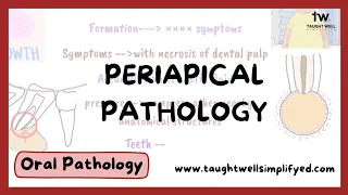 Periapical cyst - symptoms, diagnosis, differential diagnosis, treatment, theories of cyst formation