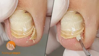 #1 Vertical nail growth and incipient mycosis | #2 Removing big toe spicules | 2 cases 1 video (VII)