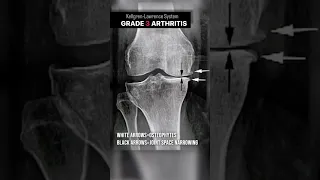 Knee Arthritis: Mild to Severe to NEW #shorts