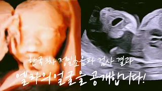 Shocking News After Diagnosis of Cleft Lip.. | Ella's 4D Ultrasound Face 👶🏻 | Return to Korea