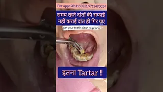 What happens when teeth are not cleaned properly- Tartar/calculus build up; Dr. Praveen Bhatia