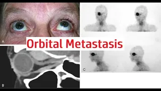 Orbital Metastasis #kanskiseries #2022bye  #2023