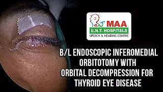 Thyroid eye disease surgery procedure | Maa Ent Hospitals