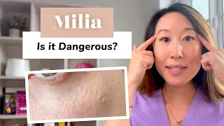 What Is Milia? Removal and Prevention | Dermatologist Guide