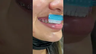 Como cepillarse los dientes con brackets paso a paso