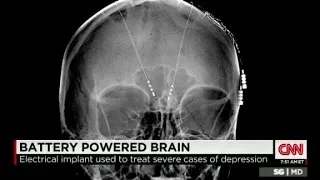 Deep brain stimulation treats depression