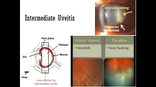 Intermediate Uveitis #KanskiSeries #2022